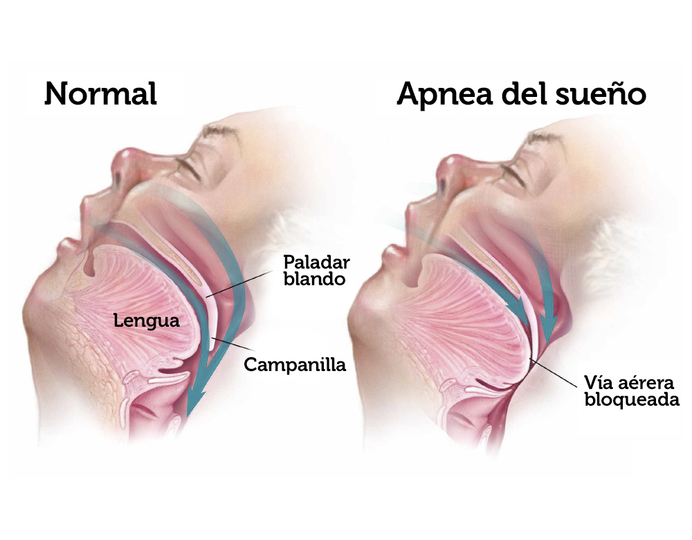 ¿Qué es la apnea del sueño y cómo afecta a tu salud dental?