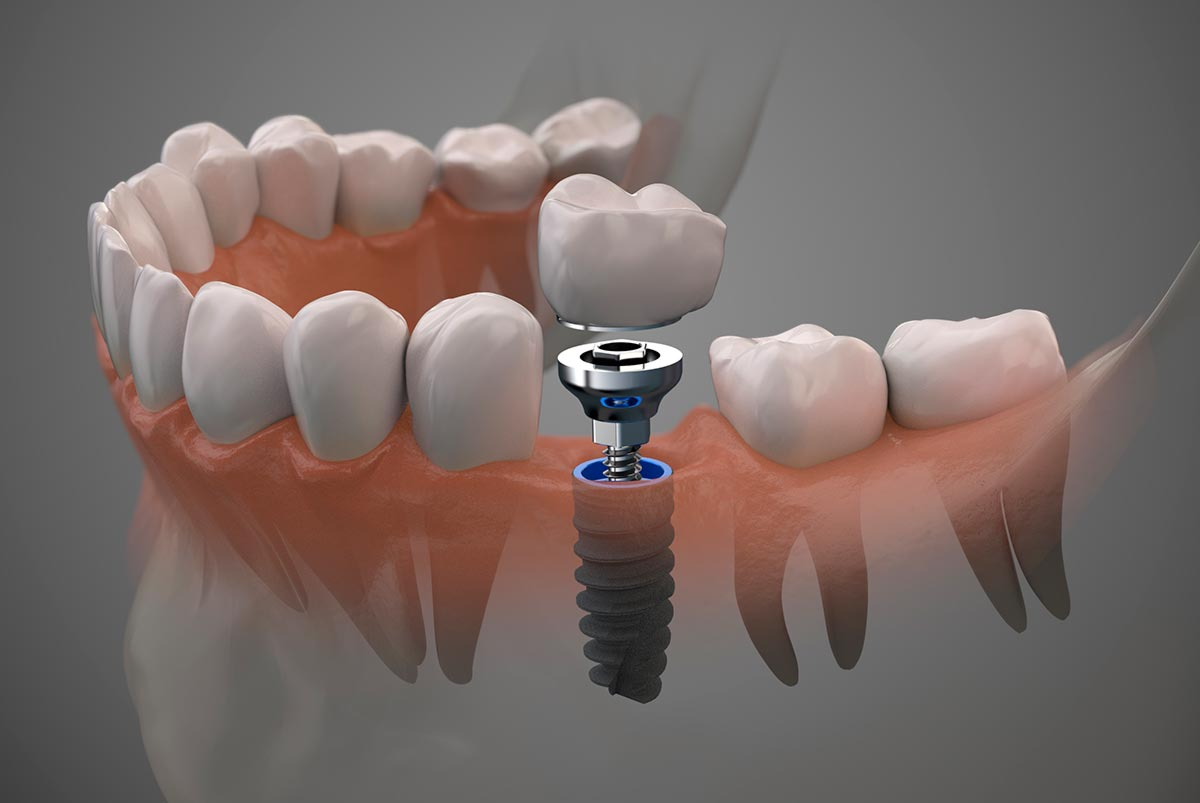 Implantes dentales y regeneración ósea: Innovaciones en la odontología moderna